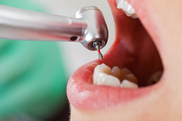 Best Emergency Wisdom Teeth Removal in Frontenac, MO